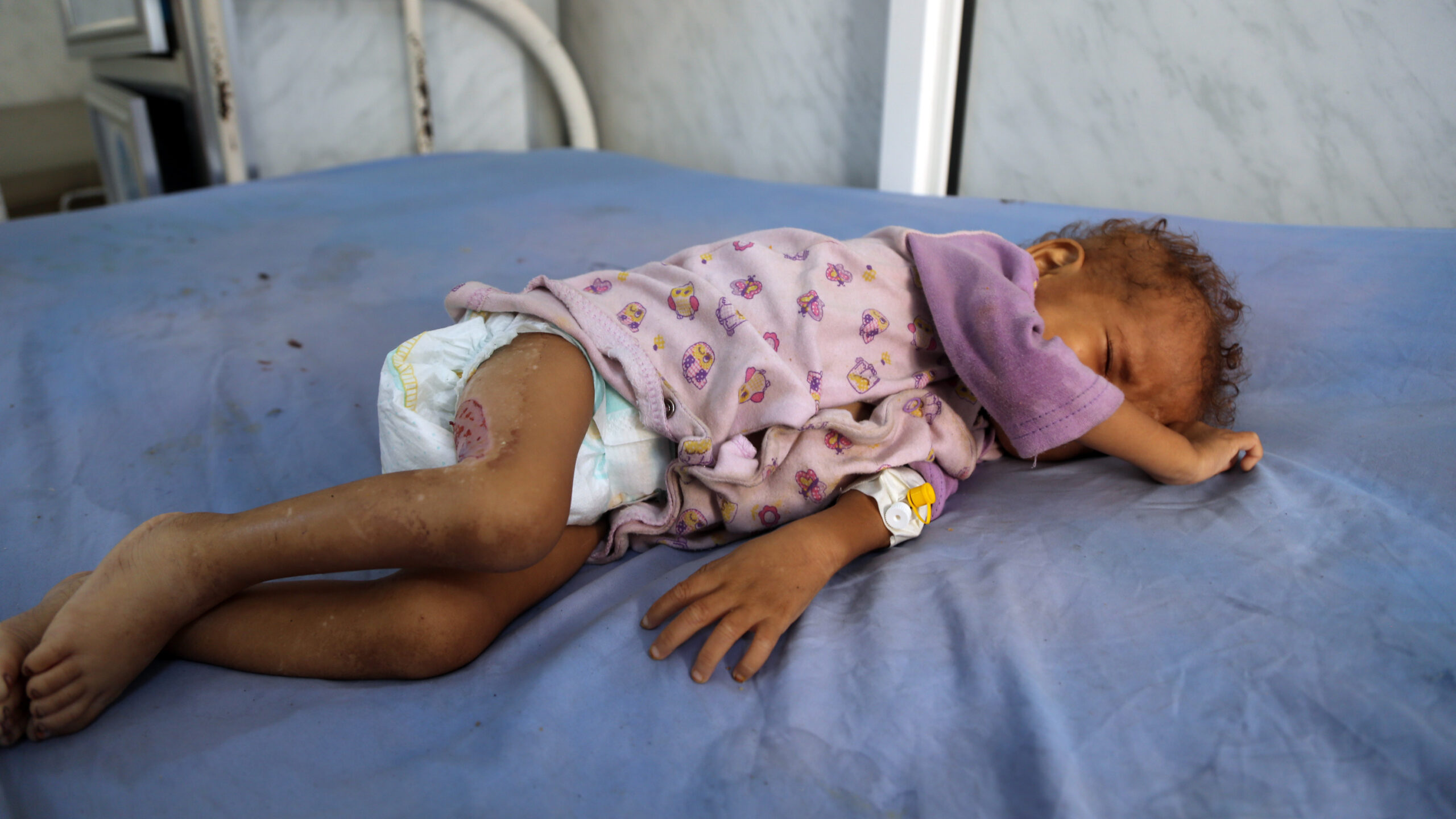 ‘a Hideous Milestone In The 21st Century Cholera Cases In Yemen Pass 1 Million Wabe 